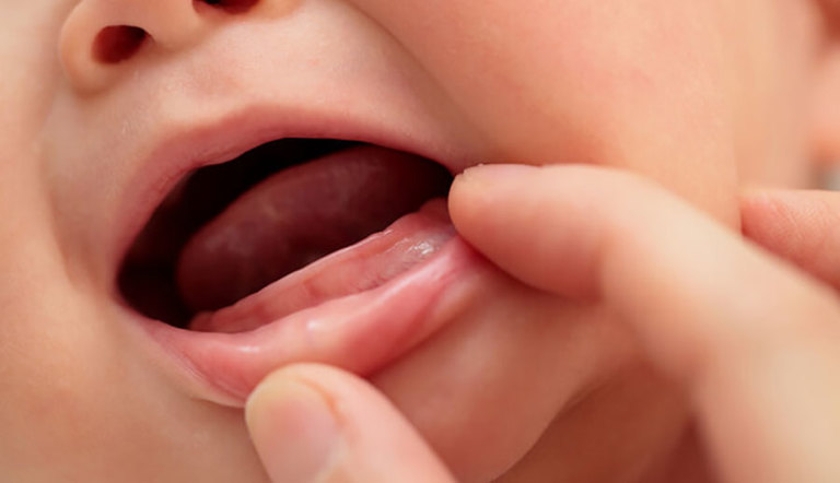 Những nguyên nhân và cách trị trẻ sơ sinh bị loét miệng 