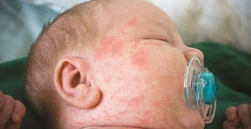 Bé gái nguy kịch do biến chứng sởi, cha mẹ cần cảnh giác biểu hiện sau